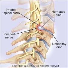 Maintaining this posture creates an angle between your trunk and your legs. Cervical Disc Damage Dallas Mobi C Spine Disk Replacement Fort Worth Herniated Neck Disc Southlake