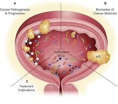 Urinary bladder cancer (ubc) is a heterogeneous disease with highly variable clinical outcomes and responses to chemotherapy. The Urinary Microbiome Implications In Bladder Cancer Pathogenesis And Therapeutics Urology