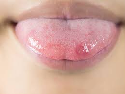 Image result for yellow tongue infection