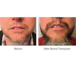 The groundbreaking article that included cases that had facial hair to head transplant was titled: Facial Transplant Beard Hair Transplant Before And After Photos Los Angeles Hair Restoration