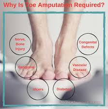 Image result for toe amputation