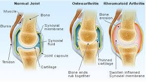 Arthritis Pain Treatment Specialists Delhi Pain Management Centre