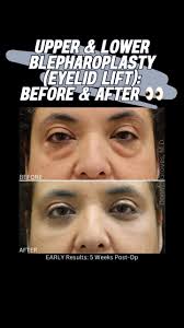 😍 UPPER & LOWER Blepharoplasty (Eyelid Lift) Surgery 👀 Before & After, .,  🔥 Early (5 Weeks) post-op results!, ., My patient had SEVERE lower eyelid  bags that were getting worse over time. She also had ...