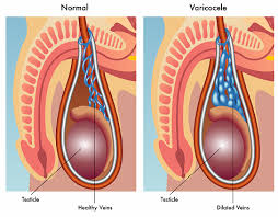 Image result for Varicocele