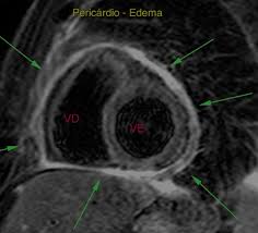 È definita miocardite un'alterazione infiammatoria che interessa lo strato intermedio della parete cardiaca: A Ressonancia Magnetica Cardiaca Tem Valor No Diagnostico Das Pericardites