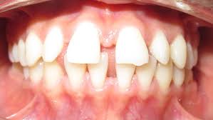 Schiefe Zahne Kieferorthopadie Lippstadt Dr Bianca Mertens