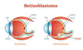 Eye cancer is any cancer that affects the eyeball or surrounding tissues. Eye Cancer Signs Symptoms And Causes Information Medanta