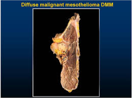 A medical professional called a pathologist examines tissue samples with a microscope and notes certain characteristics that will determine. Update On Mesothelioma Pdf Free Download
