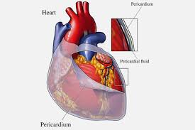 Pericarditis is an inflammation of the pericardium, the saclike membrane that surrounds the heart. Pericarditis Specialist Naples Cardiac Endovascular Center