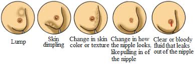 Learn the signs and symptoms of breast cancer and talk to your doctor immediately if you experience any of these signs. Early Signs Of A Possible Breast Cancer 12 18 Download Scientific Diagram