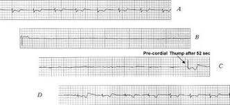 Cardiac arrest see sudden cardiac arrest (sca). Sudden Cardiac Arrest Ecg M81t1qew Ines Ventura