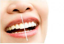 Maybe you would like to learn more about one of these? Veneers Dental Coverage By Your Dentist In Calabasas