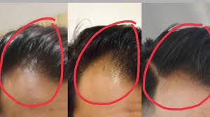 Sumber Ilham Petua Lebatkan Rambut