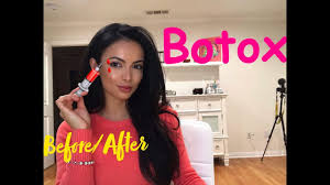 When is it time to quit botox and get a brow lift? Botox Before And After Eyebrow Lift Youtube