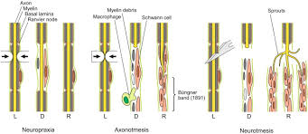 Nerve injuries as discussed previously can be created by a myriad of causes, most notably, mechanical injuries such as that produced during third molar extractions, root canal instrumentation. Axonotmesis An Overview Sciencedirect Topics
