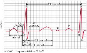 Wavelet Diagnosis Of Ecg Signals With Kaiser Based Noise