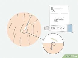 Why pubic hair is susceptible to ingrowns. How To Get Rid Of Ingrown Pubic Hair With Pictures Wikihow