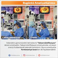 Kataraktin Gunumuzdeki Tek Tedavisi Fakoemulsifikasyon Denen Ameliyattir Fakoemulsifikasyon Ameliyatinda Ultrason Enerjsi Kullanilarak Ka Kina Tintin Bilgi