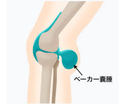 ベーカー嚢腫 - モリタ鍼灸整骨院