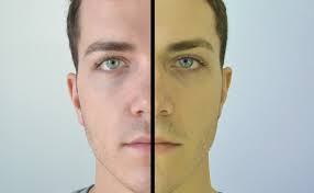 Image result for going yellow from alcoholic liver disease