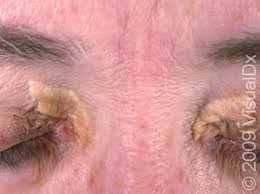 Image result for xanthelasma of eyelid