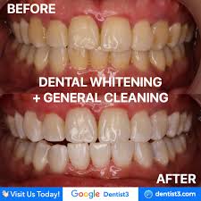 Maybe you would like to learn more about one of these? Dentist3 Teeth Whitening Clinic Malaysia Klinik Pemutihan Gigi Malaysia æ¼‚ç™½ç‰™é½¿ Dentist Malaysia