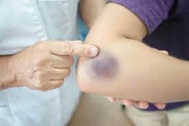 The photograph shows two types of bruising that are children who have bleeding symptoms, other than merely bruising (purpura), usually are. Purpura Sintomas Y Como Se Debe Tratar Seccion De Medicina Salud Y Bienestar
