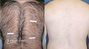 Please call 020 7998 1604 for more information. Laser Hair Removal London Pulse Light Clinic London