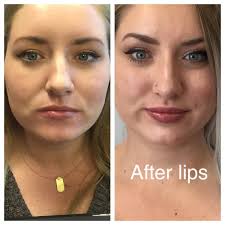 1 syringe of juvederm ultra. Interface Group On Twitter Checkout This Amazing Transformation Jordan Has Had 1 Syringe Of Voluma 2 Syringes Of Juvederm Ultra And Botox We Are Offering Bogo 1 2 Off On All Our Filler
