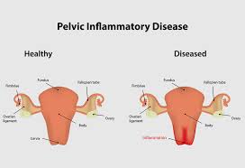 With acute pid, the symptoms are usually more severe (often sending someone to the emergency room with silent pid, a person might not experience any signs or symptoms. Pelvic Inflammatory Diseases Pid Reasons Symptoms Treatment