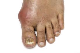 Image result for gout symptoms toe