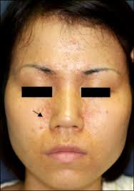 A Case of Familial Comedonal Darier's Disease