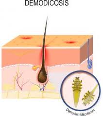 Image result for demodex rosacea