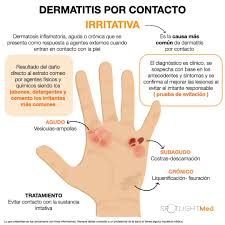 Image result for dermatitis contacta