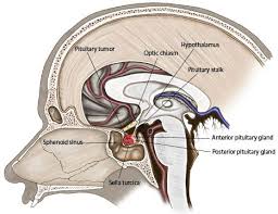 Pituitary Adenomas Sinusitis Brain Surgery Tumor