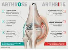 Erste symptome einer arthrose sind gelenksschmerzen bei belastung oder zu beginn der bewegung (anlaufschmerzen). Amarouche Youva Arthrose Vs Arthrite Facebook