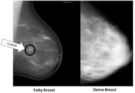What does breast cancer look like on an ultrasound?: Herscan Doing More In The Fight Against Breast Cancer With Easy Access To Ultrasound Technology South Austin Tx Patch