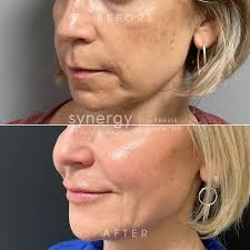 Juvéderm Facial Fillers