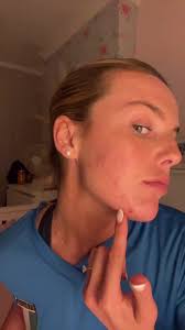 Effective Skin Care Tips for Breakout Challenges