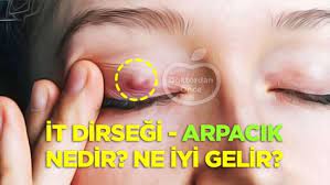 Halk Arasinda It Dirsegi Ve Arpacik Adi Verilen Goz Cevresinde Beliren Kabarti Nedir Ne Iyi Gelir Nasil Tedavi Edilir Konusunda E Sleep Eye Mask Eyes Person