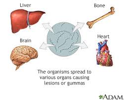Image result for Neurosyphilis