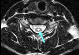 ○ 概要 １． 概要 脊髄性筋萎縮症（spinal muscular atrophy：sma）は、脊髄の前角細胞の変性による筋萎縮と進行性筋力低下を特徴とする下位運動ニューロン病である。 äº¤é€šäº‹æ•…å°‚é–€å¼è­·å£«ã«ã‚ˆã‚‹è„Šé«„æå‚· è„Šé«„ç©ºæ´žç—‡ã®å¾Œéºéšœå®³ç­‰ç´šèªå®šã®ãƒã‚¤ãƒ³ãƒˆ å…¬å¼ ã«ã‚æ³•å¾‹äº‹å‹™æ‰€