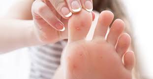 فقاعات القدم أسبابها وطرق علاجها ويب طب