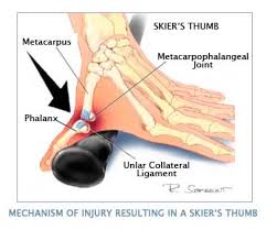 Hyperabduction of the thumb with pain and swelling, especially around the mcp joint. Skier S Thumb Physiopedia