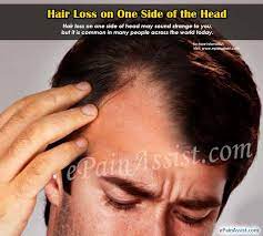 It was first described in 1994. Hair Loss On One Side Of The Head Causes Treatment Diagnosis