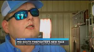 Firefighter's life back to normal after successful face transplant