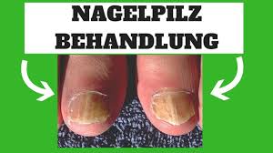 Nagelpilz Behandlung Hausmittel Gegen Nagelpilz Die Wirklich Helfen Schnell Youtube