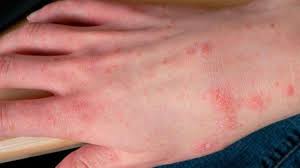 Sexual contact is the most common form of transmission among sexually active young people, and scabies has been considered by many to be a sexually. Scabies Tribunnewswiki Com Mobile