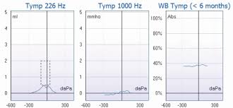 Image result for Tympanometry