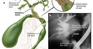 Gastroenterology And Hepatology Johns Hopkins Medicine In Baltimore Md Bile Duct Cancer Awareness Bile Duct Cancer Bile Duct